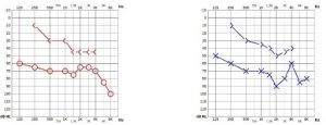 Grafico audiometrico orecchio destro e sinistro